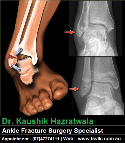 townsville ankle fracture surgery specialist dr kaushik hazratwala