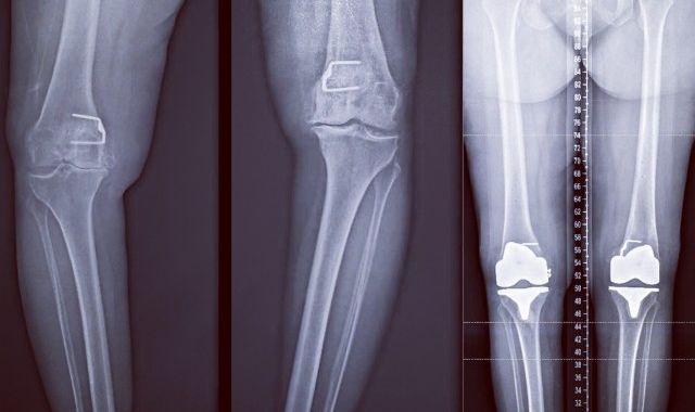 Bilateral (2) Hip and Knee Replacements