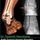 Go to Early Mobilisation reduces the risk of complications in Ankle Fracture Fixation Surgery