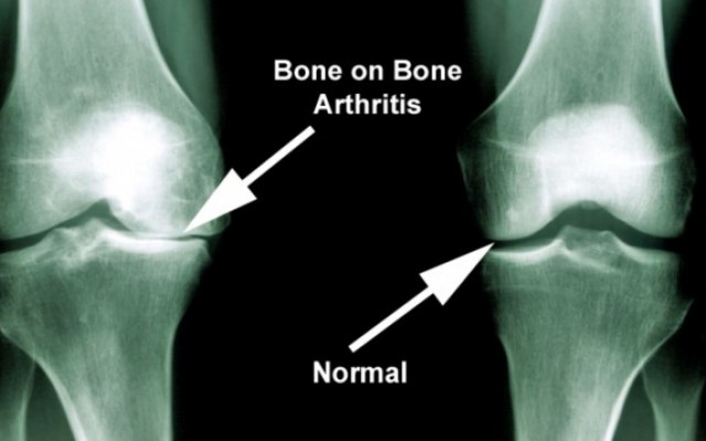 What is Osteoarthritis?