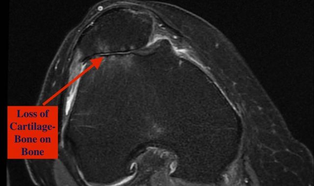 Patella-Femoral Joint Arthritis