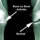 Go to What is Osteoarthritis?