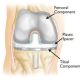 How old is too Young for Hip and knee arthroplasty