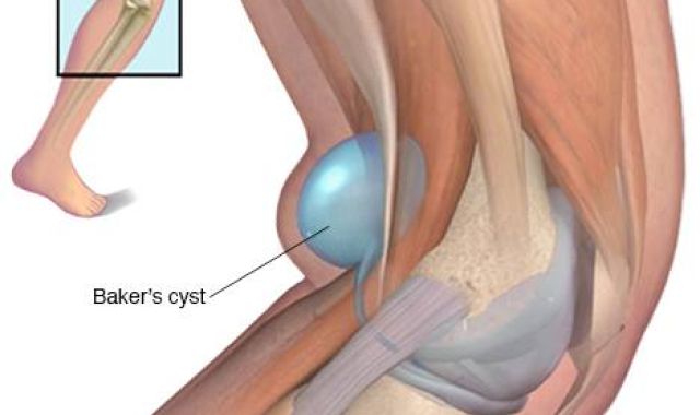 Baker's Cyst of The Knee