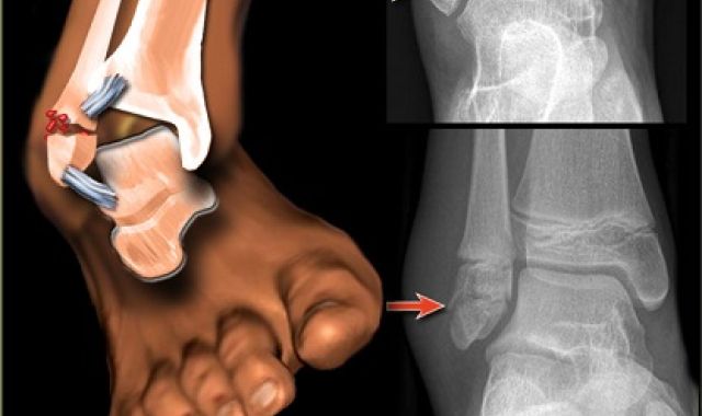 Early Mobilisation reduces the risk of complications in Ankle Fracture Fixation Surgery
