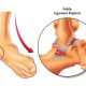 Go to Chronic Ankle Instability
