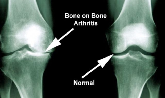 What is Osteoarthritis?